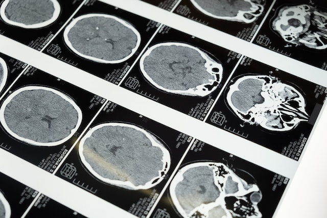 Multiple black and white brain CT scan images are laid out in rows, showing cross-sectional views of the human brain at different levels, commonly examined for concussion symptoms after a car crash.